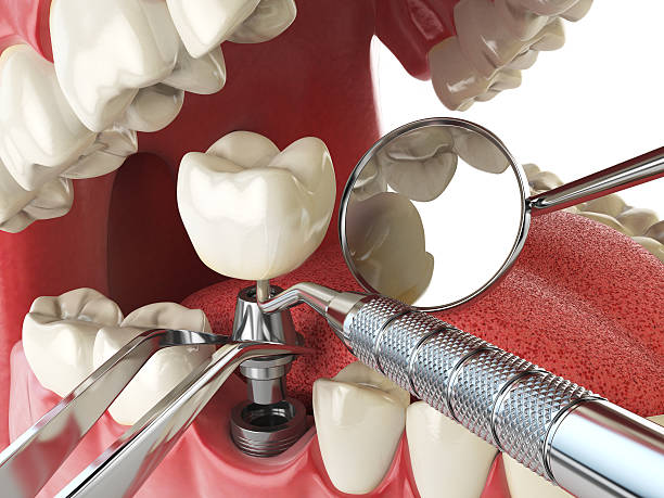 Best Broken or Chipped Tooth Repair in Woodland, WA